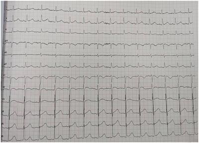 Immune myocarditis related to sintilimab treatment in a patient with advanced lung adenocarcinoma: A case report